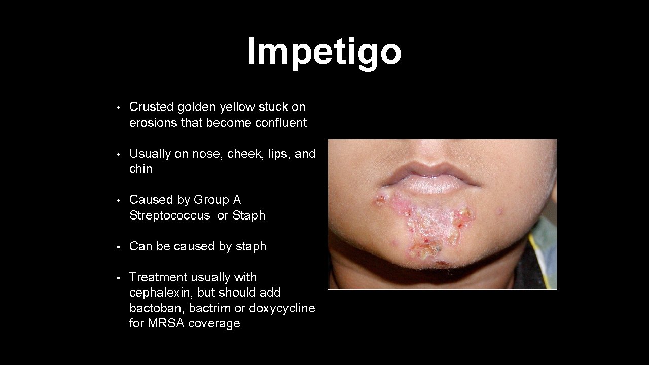 Impetigo • Crusted golden yellow stuck on erosions that become confluent • Usually on