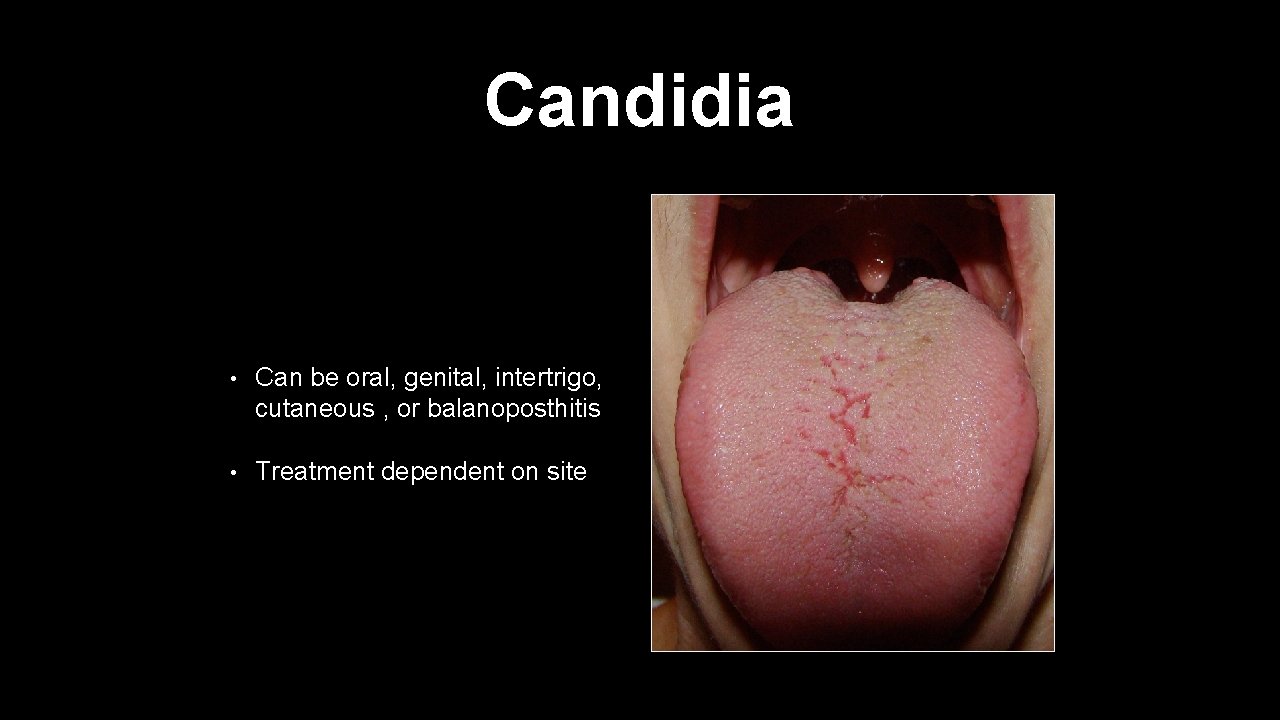 Candidia • Can be oral, genital, intertrigo, cutaneous , or balanoposthitis • Treatment dependent