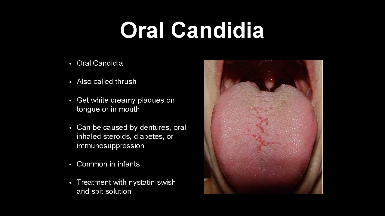 Oral Candidia • Oral Candidia • Also called thrush • Get white creamy plaques
