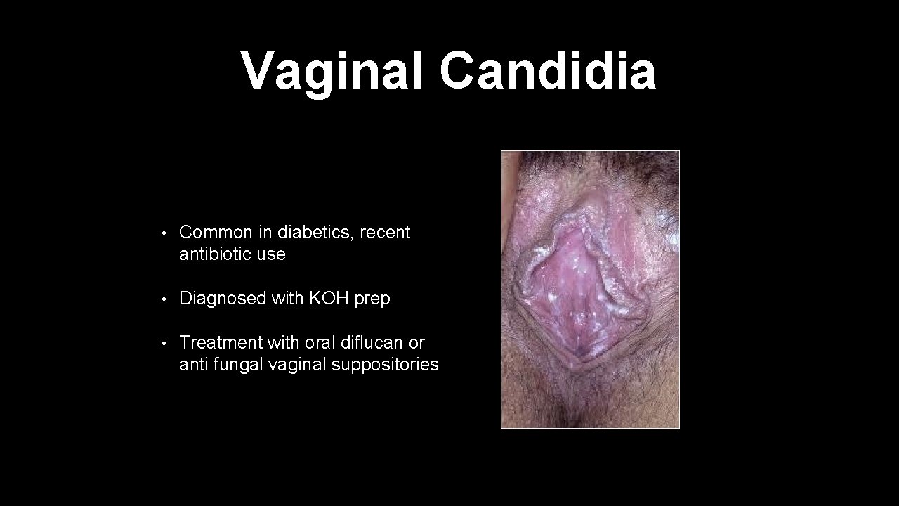 Vaginal Candidia • Common in diabetics, recent antibiotic use • Diagnosed with KOH prep