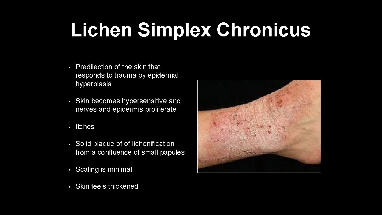 Lichen Simplex Chronicus • Predilection of the skin that responds to trauma by epidermal