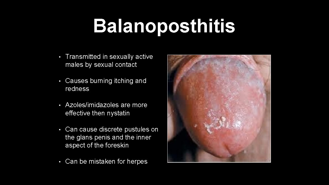 Balanoposthitis • Transmitted in sexually active males by sexual contact • Causes burning itching