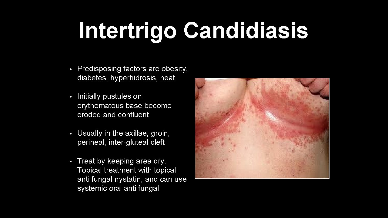 Intertrigo Candidiasis • Predisposing factors are obesity, diabetes, hyperhidrosis, heat • Initially pustules on