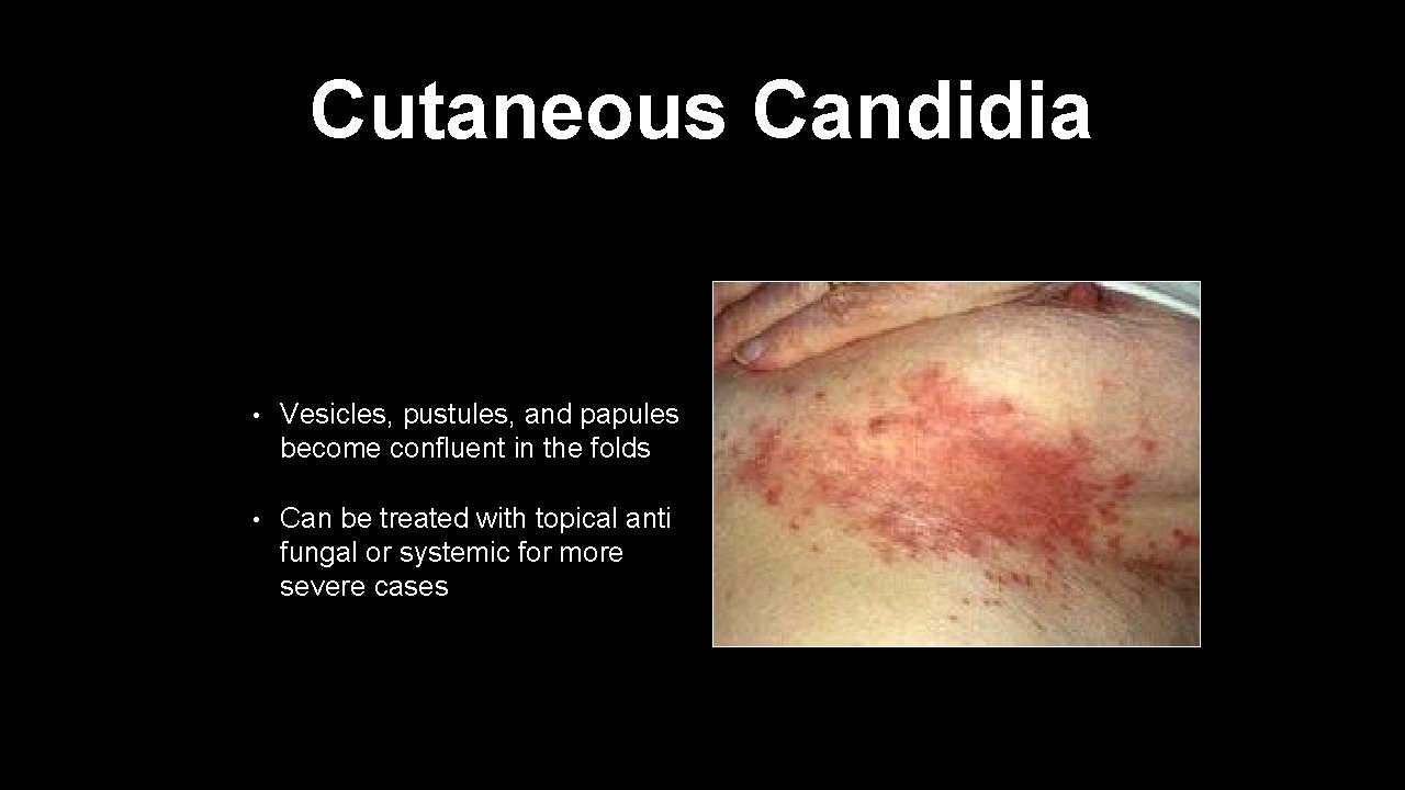 Cutaneous Candidia • Vesicles, pustules, and papules become confluent in the folds • Can