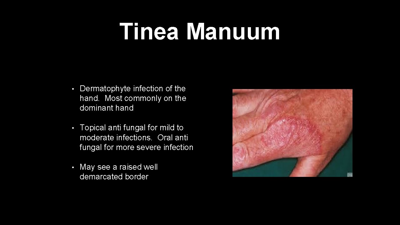 Tinea Manuum • Dermatophyte infection of the hand. Most commonly on the dominant hand