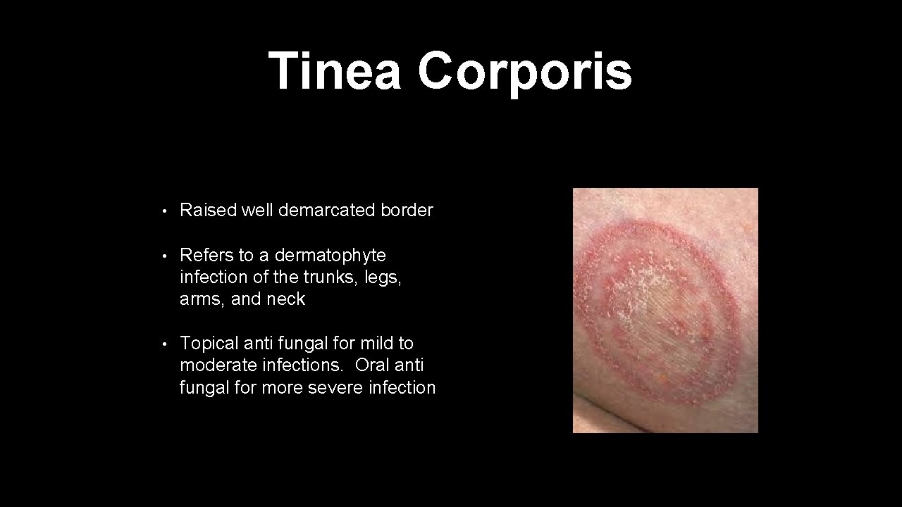 Tinea Corporis • Raised well demarcated border • Refers to a dermatophyte infection of