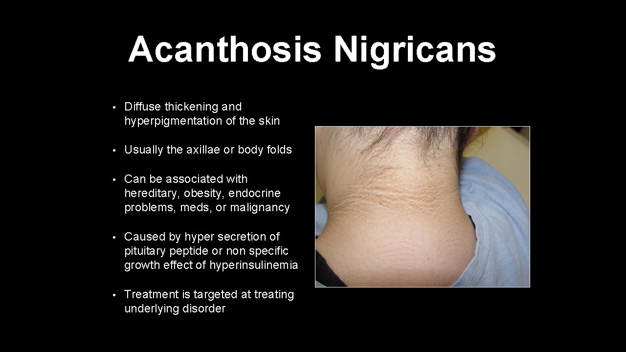 Acanthosis Nigricans • Diffuse thickening and hyperpigmentation of the skin • Usually the axillae