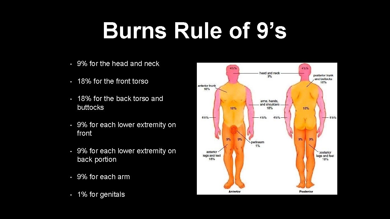 Burns Rule of 9’s • 9% for the head and neck • 18% for