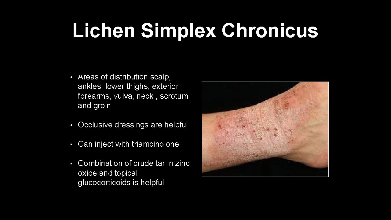 Lichen Simplex Chronicus • Areas of distribution scalp, ankles, lower thighs, exterior forearms, vulva,