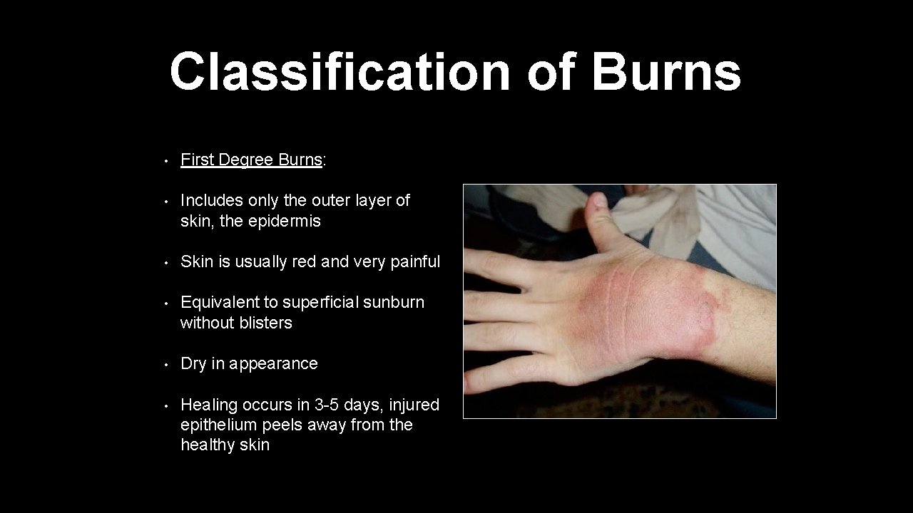 Classification of Burns • First Degree Burns: • Includes only the outer layer of