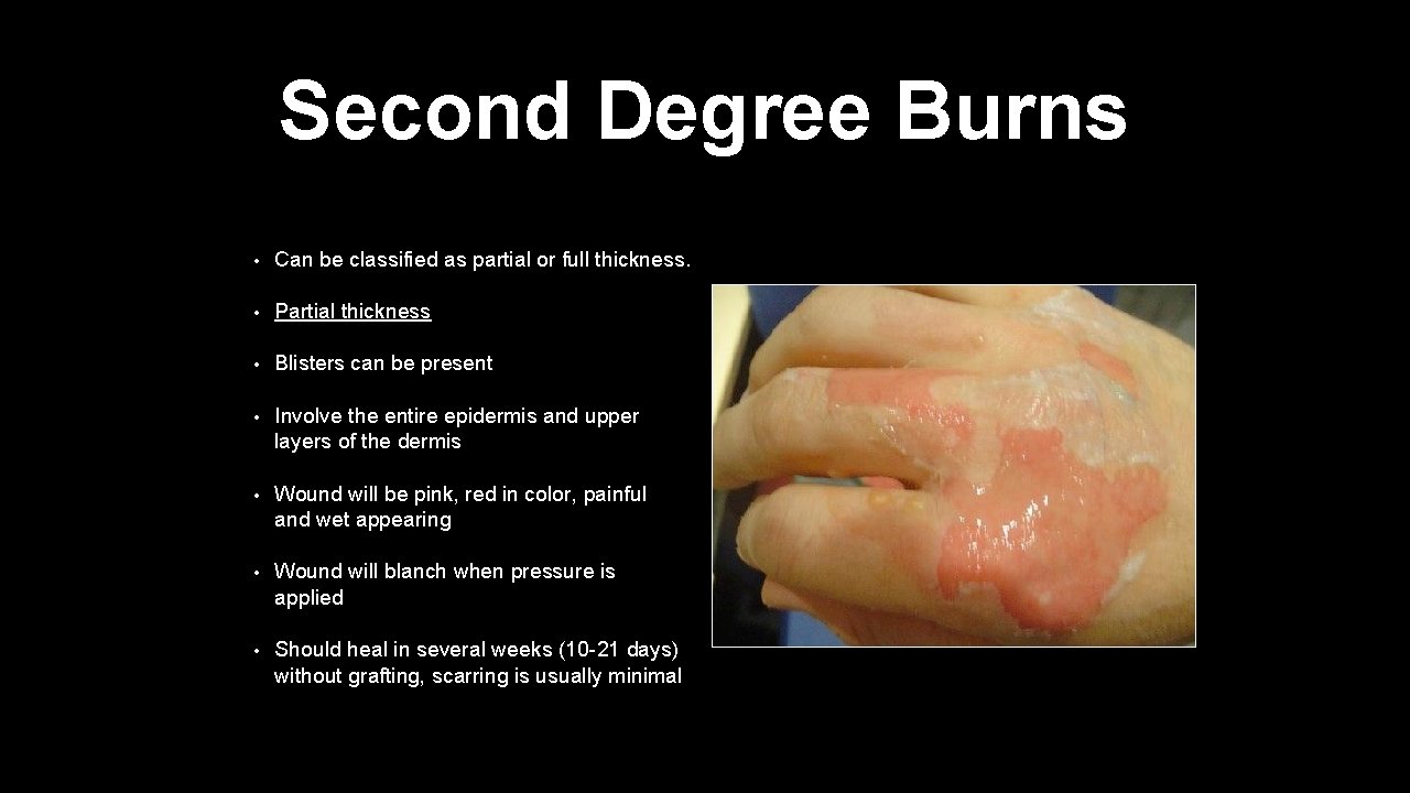 Second Degree Burns • Can be classified as partial or full thickness. • Partial