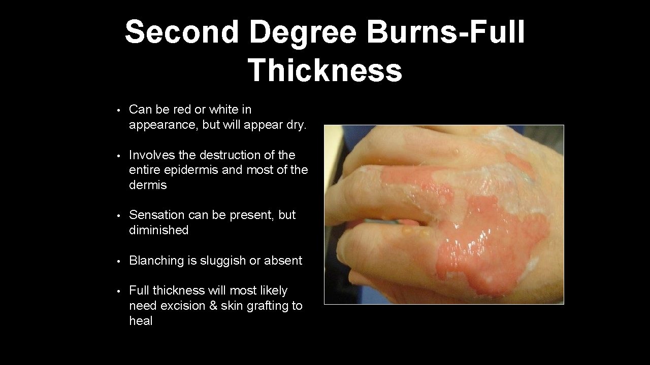 Second Degree Burns-Full Thickness • Can be red or white in appearance, but will