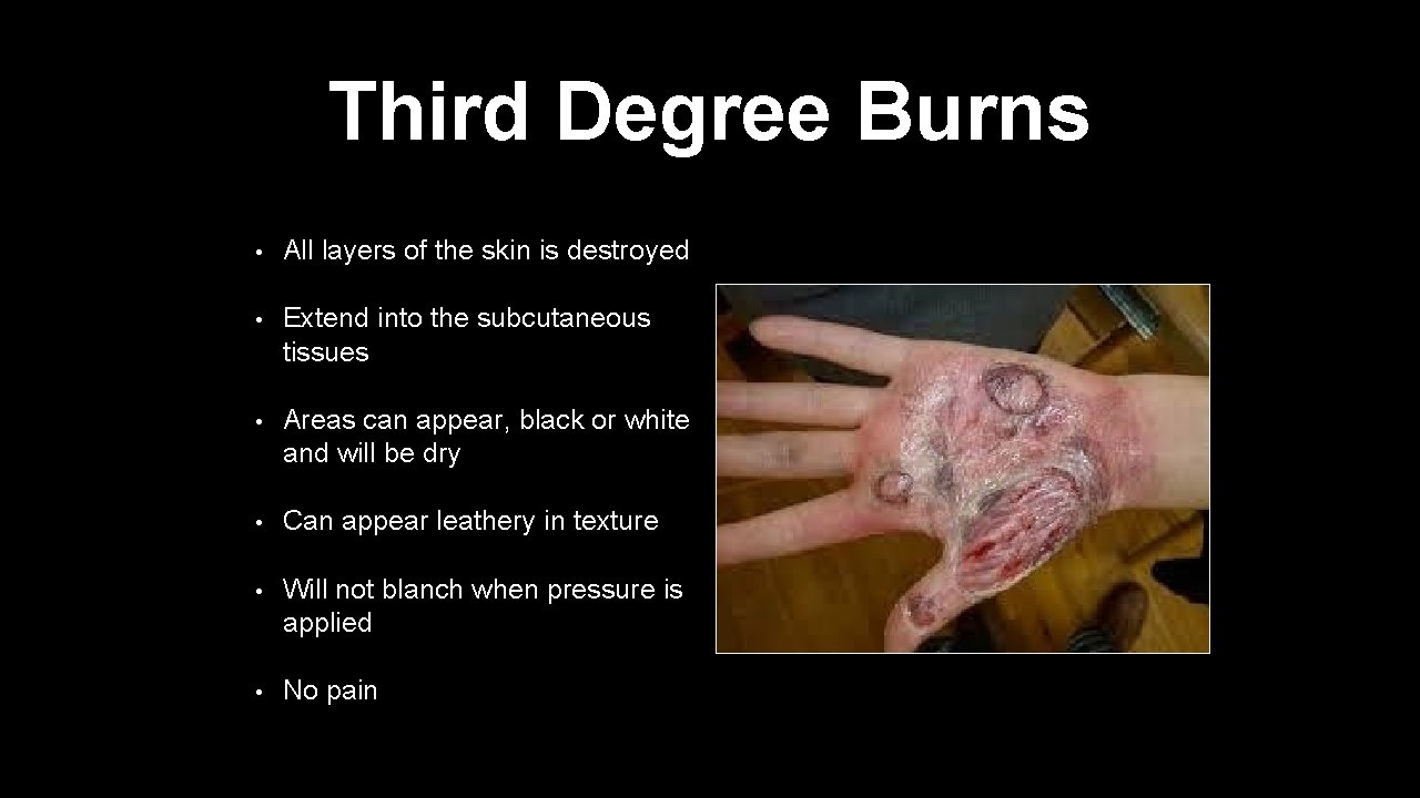 Third Degree Burns • All layers of the skin is destroyed • Extend into