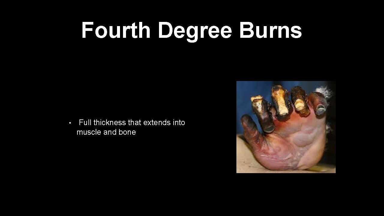 Fourth Degree Burns • Full thickness that extends into muscle and bone 