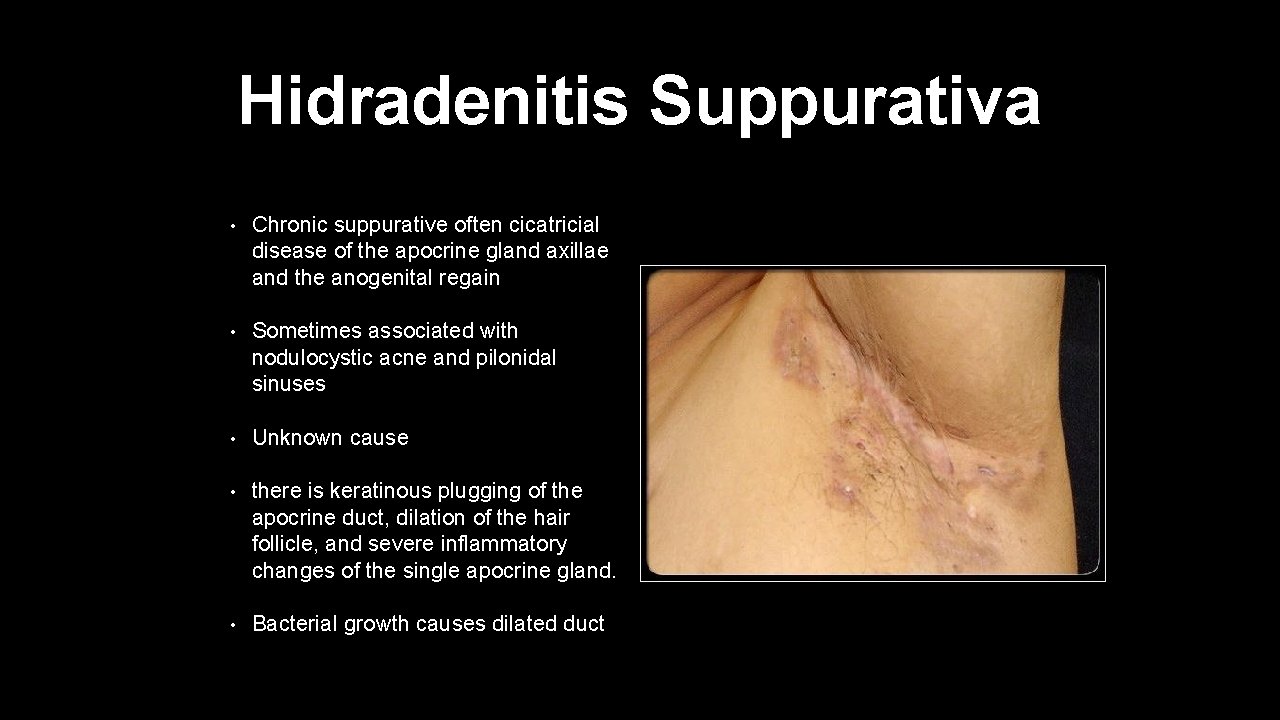 Hidradenitis Suppurativa • Chronic suppurative often cicatricial disease of the apocrine gland axillae and