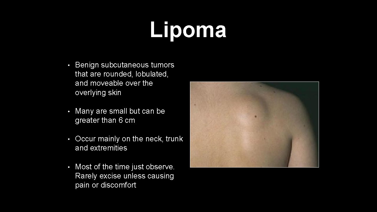 Lipoma • Benign subcutaneous tumors that are rounded, lobulated, and moveable over the overlying