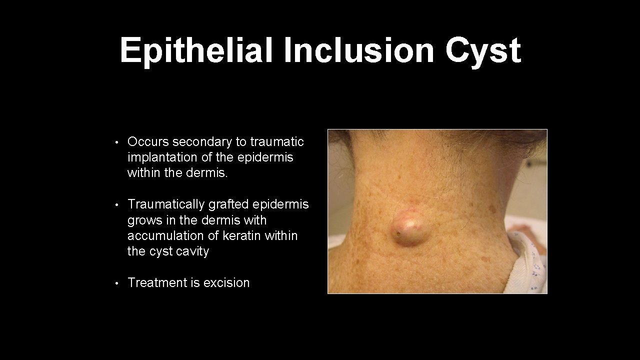Epithelial Inclusion Cyst • Occurs secondary to traumatic implantation of the epidermis within the