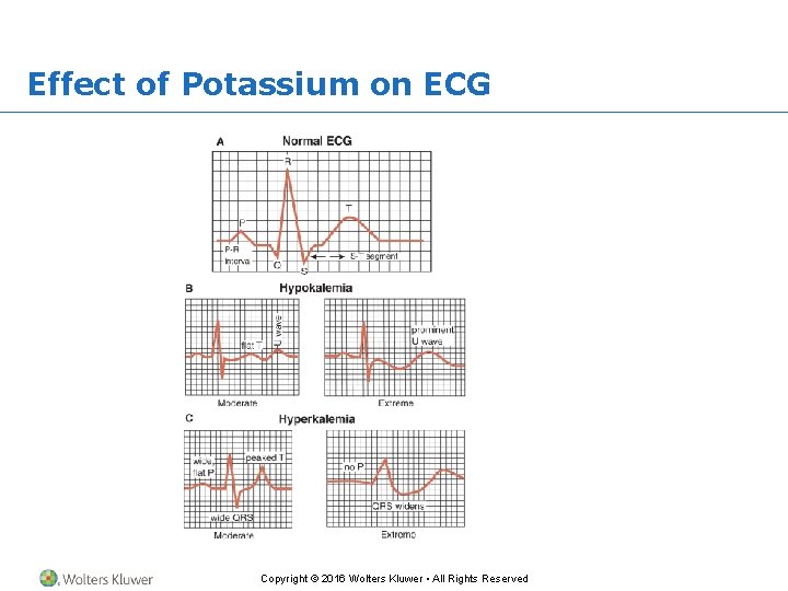 Effect of Potassium on ECG Copyright © 2016 Wolters Kluwer • All Rights Reserved