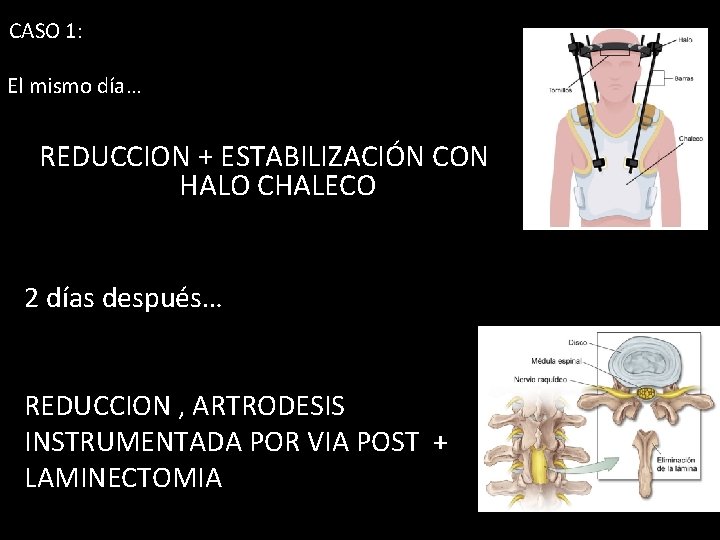 CASO 1: El mismo día… REDUCCION + ESTABILIZACIÓN CON HALO CHALECO 2 días después…