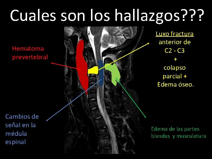 Cuales son los hallazgos? ? ? Hematoma prevertebral Cambios de señal en la médula