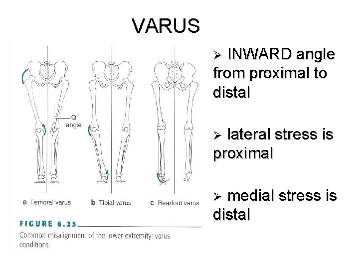 VARUS INWARD angle from proximal to distal Ø lateral stress is proximal Ø medial