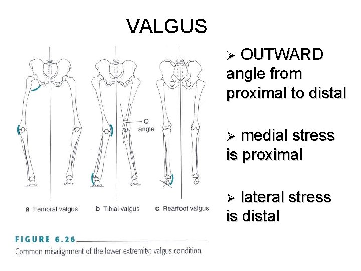 VALGUS OUTWARD angle from proximal to distal Ø medial stress is proximal Ø lateral