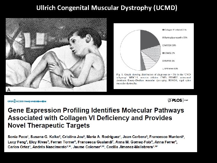 Ullrich Congenital Muscular Dystrophy (UCMD) 