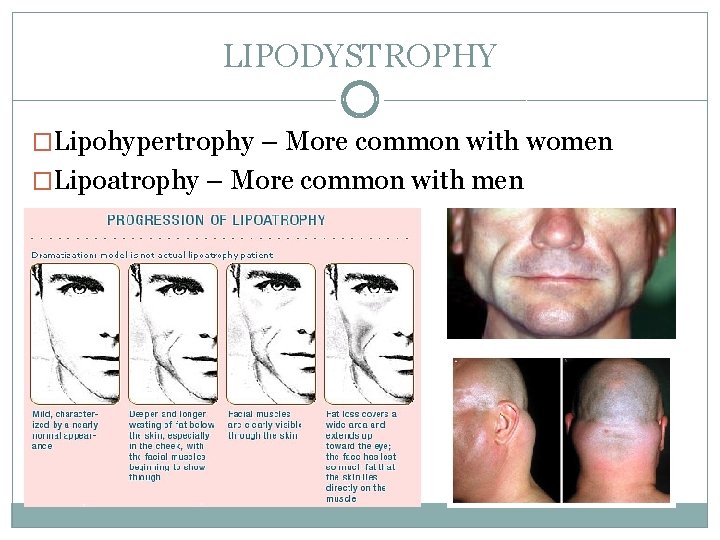 LIPODYSTROPHY �Lipohypertrophy – More common with women �Lipoatrophy – More common with men 