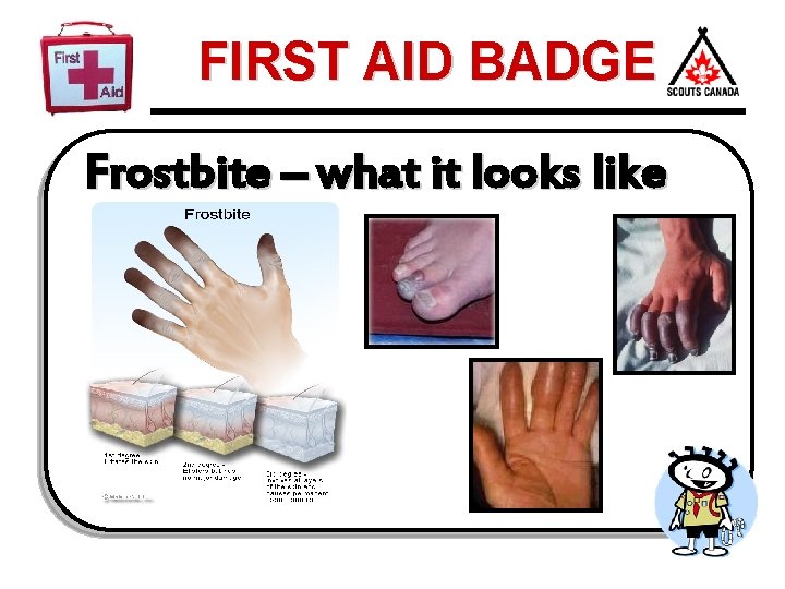 FIRST AID BADGE Frostbite – what it looks like 