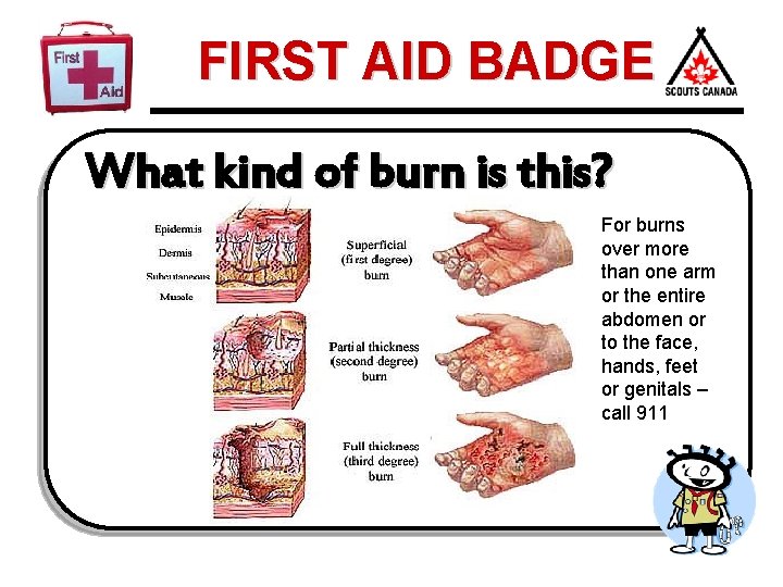 FIRST AID BADGE What kind of burn is this? For burns over more than