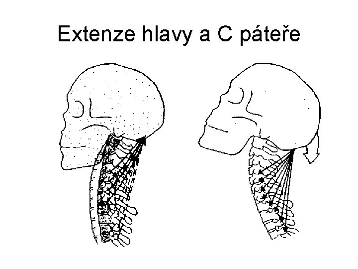 Extenze hlavy a C páteře 