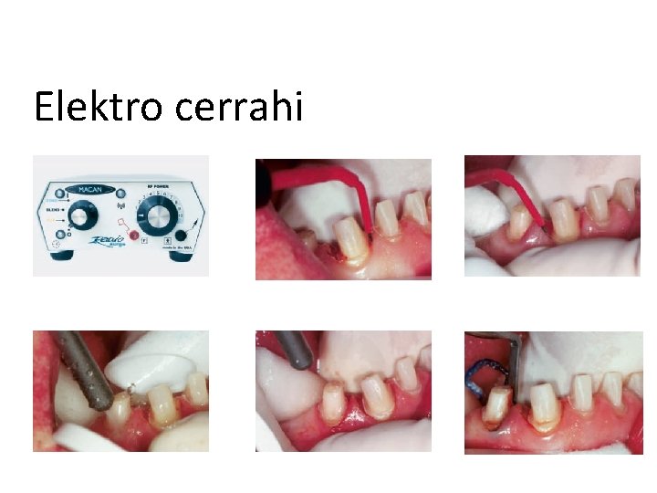 Elektro cerrahi 