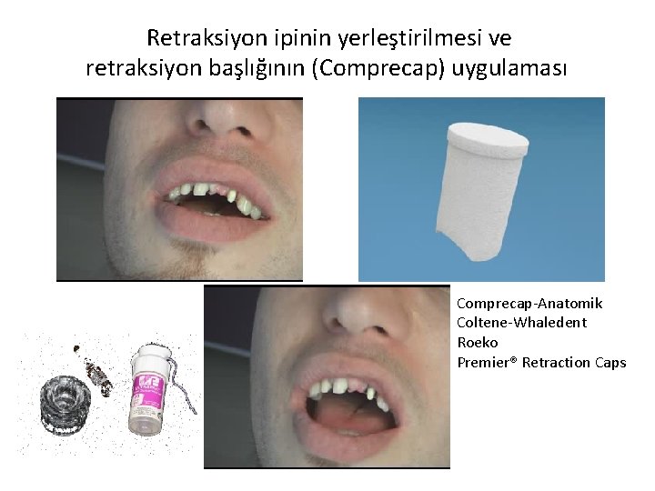 Retraksiyon ipinin yerleştirilmesi ve retraksiyon başlığının (Comprecap) uygulaması Comprecap Anatomik Coltene Whaledent Roeko Premier®