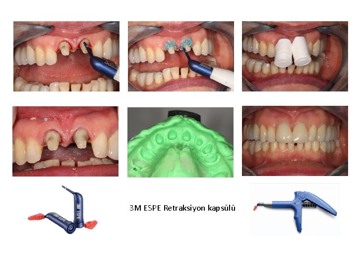 3 M ESPE Retraksiyon kapsülü 