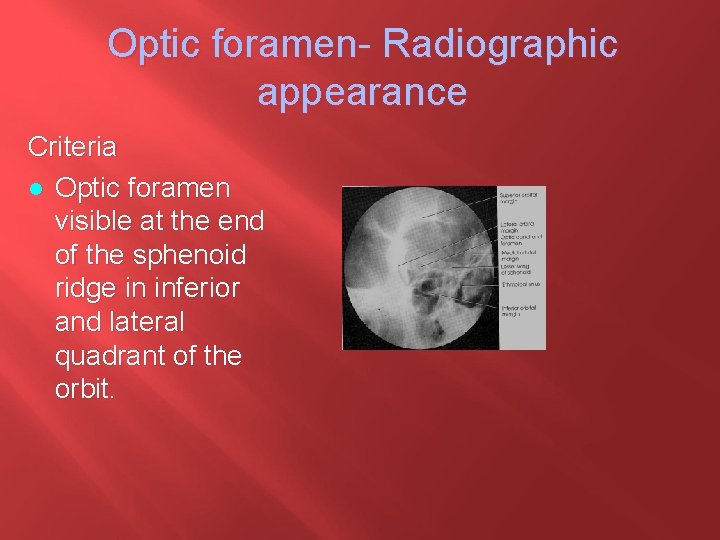 Optic foramen- Radiographic appearance Criteria l Optic foramen visible at the end of the