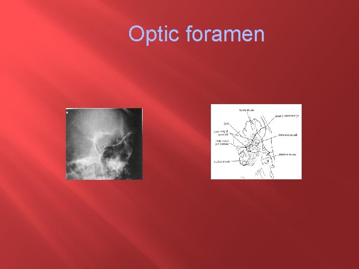 Optic foramen 