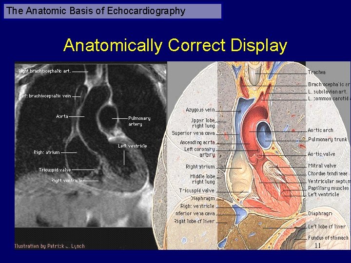 The Anatomic Basis of Echocardiography Anatomically Correct Display 11 