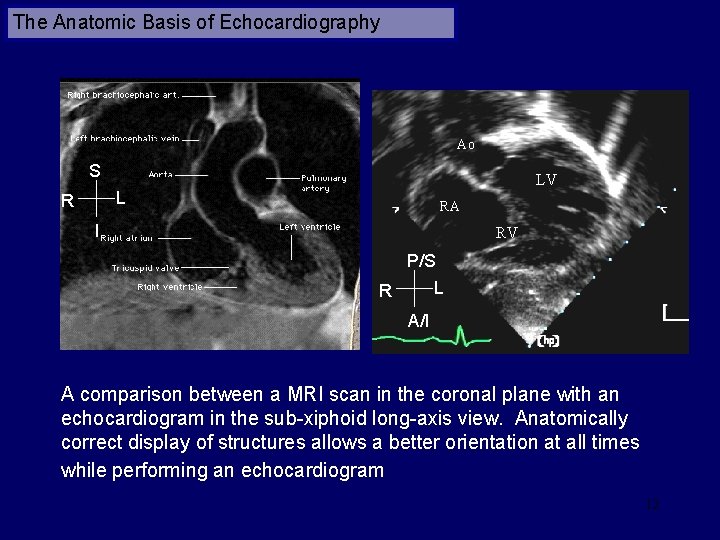 The Anatomic Basis of Echocardiography Ao S LV L R RA I RV P/S