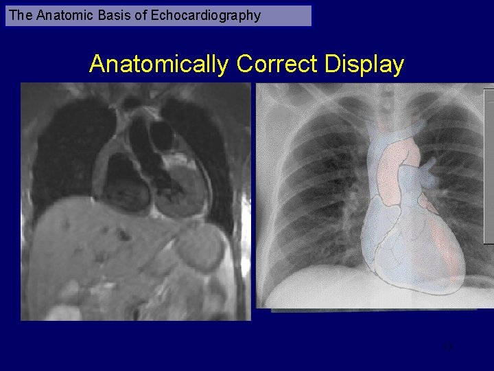 The Anatomic Basis of Echocardiography Anatomically Correct Display 13 