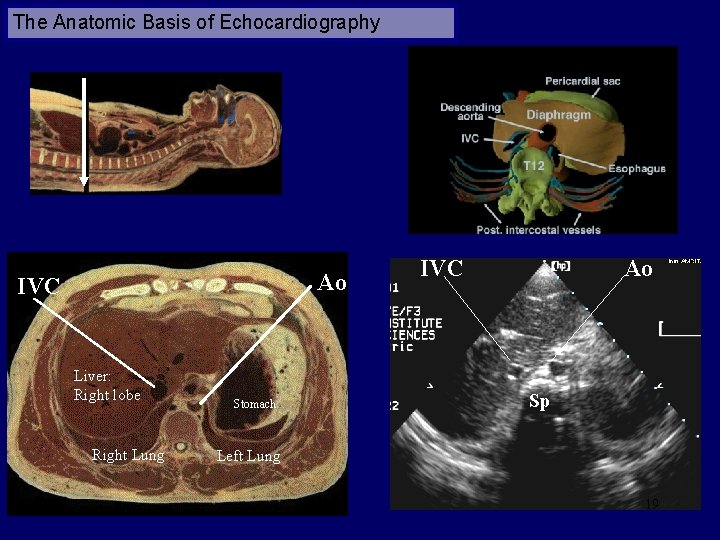 The Anatomic Basis of Echocardiography Ao IVC Liver: Right lobe Right Lung Stomach IVC