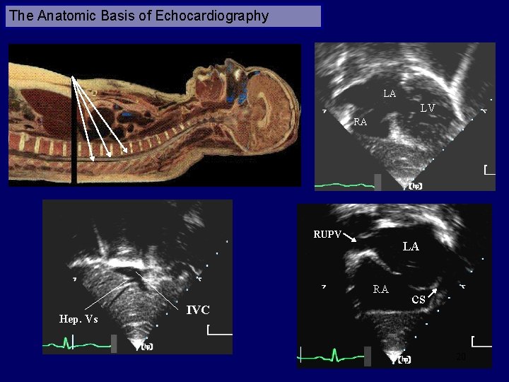 The Anatomic Basis of Echocardiography LA LV RA RUPV LA RA Hep. Vs IVC