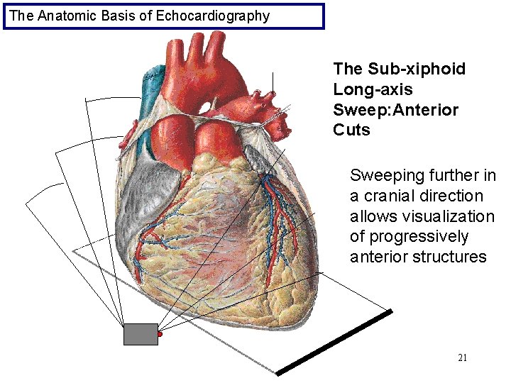 The Anatomic Basis of Echocardiography The Sub-xiphoid Long-axis Sweep: Anterior Cuts Sweeping further in