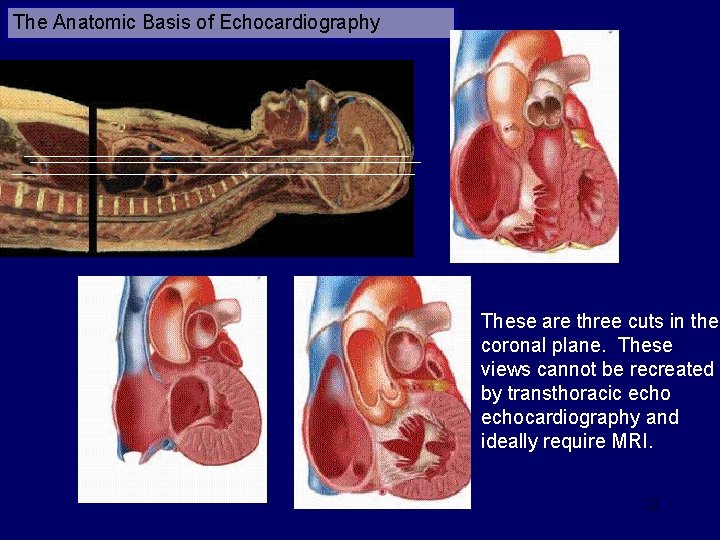 The Anatomic Basis of Echocardiography These are three cuts in the coronal plane. These