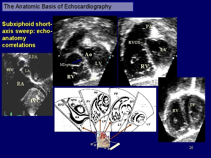 The Anatomic Basis of Echocardiography Subxiphoid shortaxis sweep: echoanatomy correlations PA RVOT Ao RPA