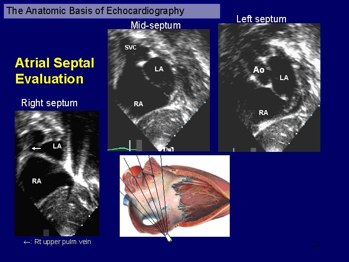 The Anatomic Basis of Echocardiography Mid-septum Left septum SVC Atrial Septal Evaluation Right septum
