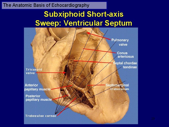 The Anatomic Basis of Echocardiography Subxiphoid Short-axis Sweep: Ventricular Septum 29 