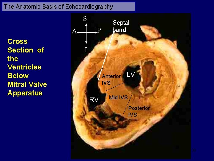 The Anatomic Basis of Echocardiography S P A Cross Section of the Ventricles Below