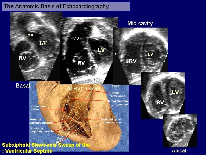 The Anatomic Basis of Echocardiography Mid cavity PA Ao LV RVOT LV RV Basal