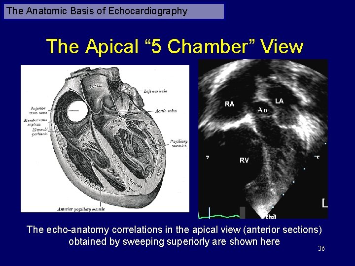 The Anatomic Basis of Echocardiography The Apical “ 5 Chamber” View LA RA Ao