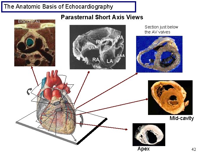 The Anatomic Basis of Echocardiography Branch PAs Parasternal Short Axis Views Section just below